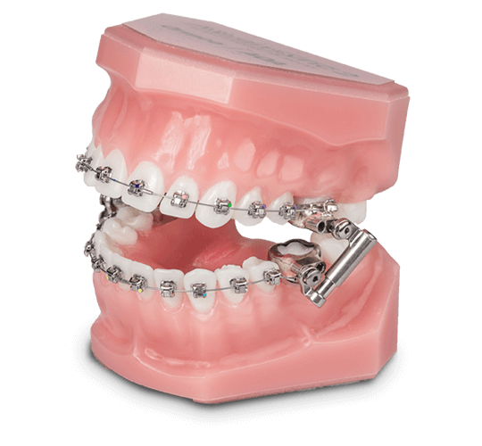 Apribocca con ali extra e intraorali, bianco - Negozio Ortho Depot per  ortodontisti, dentisti e cliniche
