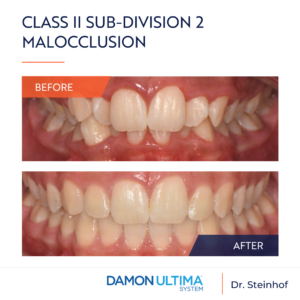 Malocclusione di Classe II seconda divisione con un significativo affollamento mascellare e mandibolare