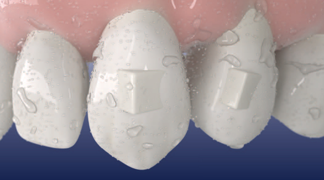 032 Aligner attachements